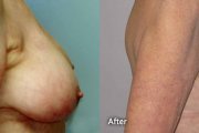 Breast reshaping and implants
