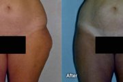 Before & After Thigh Liposuction Danville