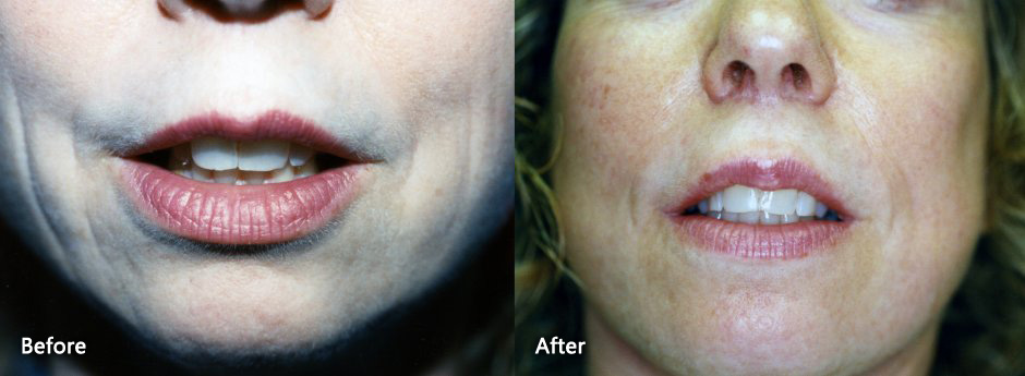Lip Enhancement & Rejunivation Danville