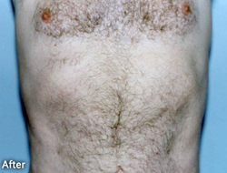 Tummy Tucks (Abdominoplasty) Patient 58162 After Photo # 2