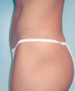 Tummy Tucks (Abdominoplasty) Patient 54015 After Photo # 4