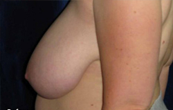 Breast Augmentation Patient 43313 Before Photo # 3