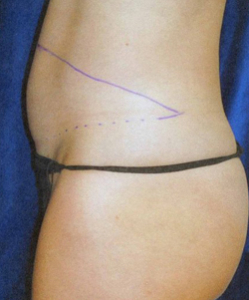 Tummy Tucks (Abdominoplasty) Patient 54015 Before Photo # 5