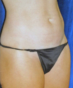 Tummy Tucks (Abdominoplasty) Patient 54015 Before Photo # 1