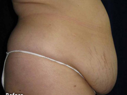 Tummy Tucks (Abdominoplasty) Patient 79931 Before Photo # 1