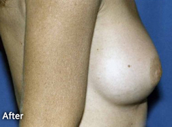 Breast Augmentation Patient 47293 After Photo # 2