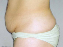 Tummy Tucks (Abdominoplasty) Patient 94223 Before Photo # 3