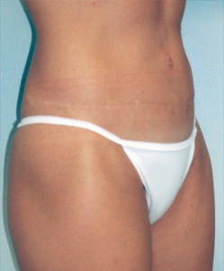 Tummy Tucks (Abdominoplasty) Patient 54015 After Photo # 2