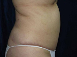 Tummy Tucks (Abdominoplasty) Patient 79931 After Photo # 2