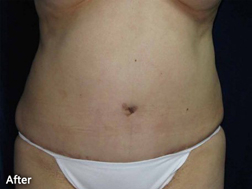 Tummy Tucks (Abdominoplasty) Patient 79931 After Photo # 4