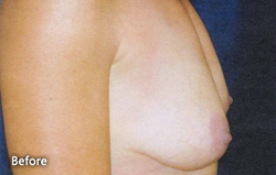 Breast Augmentation Patient 43313 Before Photo # 5