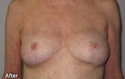 Breast Reduction Patient 96613 After Photo # 4