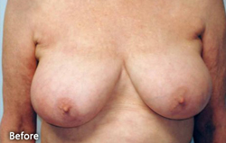 Breast Reduction Patient 96613 Before Photo # 3