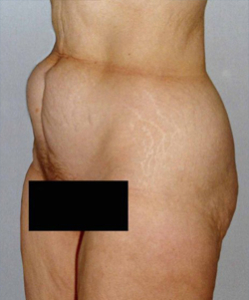 Body Contouring After Large Weight Loss Patient 98128 Before Photo # 1