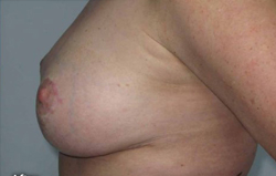 Breast Augmentation Patient 43313 After Photo # 4