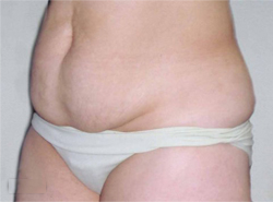 Tummy Tucks (Abdominoplasty) Patient 94223 Before Photo # 1