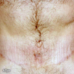 Body Contouring After Large Weight Loss Patient 33439 After Photo # 2