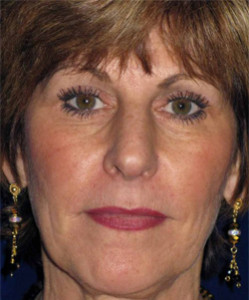 58-year-old 1 year before face and neck lift surgery