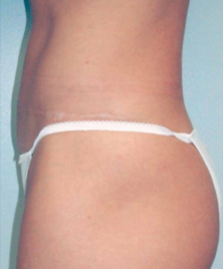 Tummy Tucks (Abdominoplasty) Patient 54015 After Photo # 6