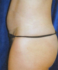 Tummy Tucks (Abdominoplasty) Patient 54015 Before Photo # 3