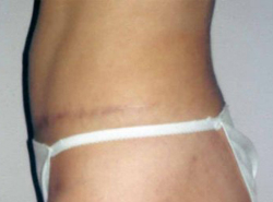 Tummy Tucks (Abdominoplasty) Patient 94223 After Photo # 4