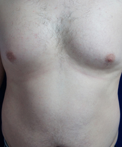 Tummy Tucks (Abdominoplasty) Patient 66442 Before Photo # 1