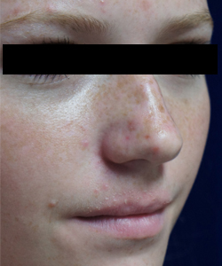 Nose Surgery Patient 27467 Before Photo # 7