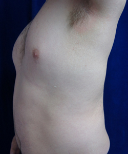 Tummy Tucks (Abdominoplasty) Patient 66442 Before Photo # 5