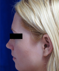 Nose Surgery Patient 27467 Before Photo # 3