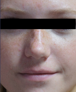 Nose Surgery Patient 27467 Before Photo # 5