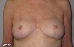 Breast Reshaping Patient 70856 After Photo # 4