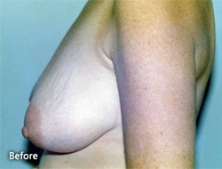 Breast Reshaping Patient 59582 Before Photo # 1