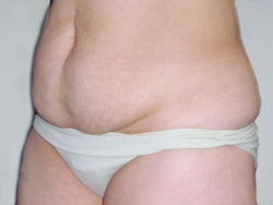 Tummy Tucks (Abdominoplasty) Patient 30368 Before Photo # 3