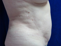 Tummy Tucks (Abdominoplasty) Patient 11305 After Photo # 2