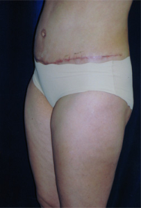 Tummy Tucks (Abdominoplasty) Patient 63474 After Photo # 2