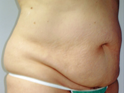 Tummy Tucks (Abdominoplasty) Patient 11305 Before Photo # 3