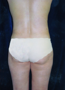 Tummy Tucks (Abdominoplasty) Patient 25214 After Photo # 4