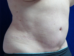 Tummy Tucks (Abdominoplasty) Patient 11305 After Photo # 4