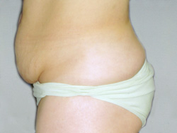 Tummy Tucks (Abdominoplasty) Patient 30368 Before Photo # 5