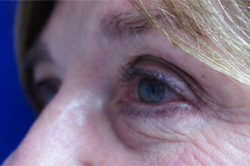 Eyelid Surgery Patient 53230 Before Photo # 3