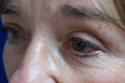 Eyelid Surgery Patient 53230 After Photo # 4