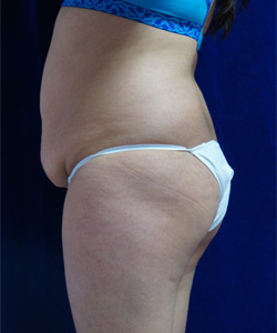 Tummy Tucks (Abdominoplasty) Patient 77291 Before Photo # 5