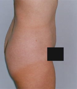 Tummy Tucks (Abdominoplasty) Patient 68964 After Photo # 4