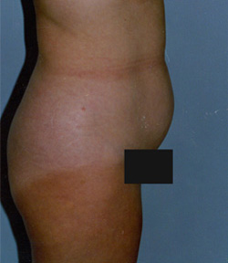 Tummy Tucks (Abdominoplasty) Patient 68964 Before Photo # 3