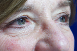 Eyelid Surgery Patient 53230 Before Photo # 5