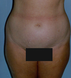 Tummy Tucks (Abdominoplasty) Patient 68964 Before Photo # 1