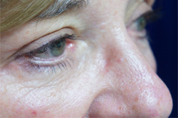 Eyelid Surgery Patient 53230 After Photo # 6
