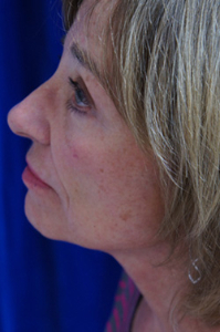 Forehead Lift Patient 79544 After Photo # 4