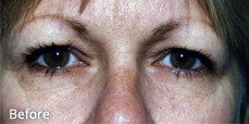 47-year-old before upper eyelid surgery.