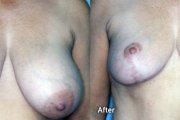 Breast reshaping and implants